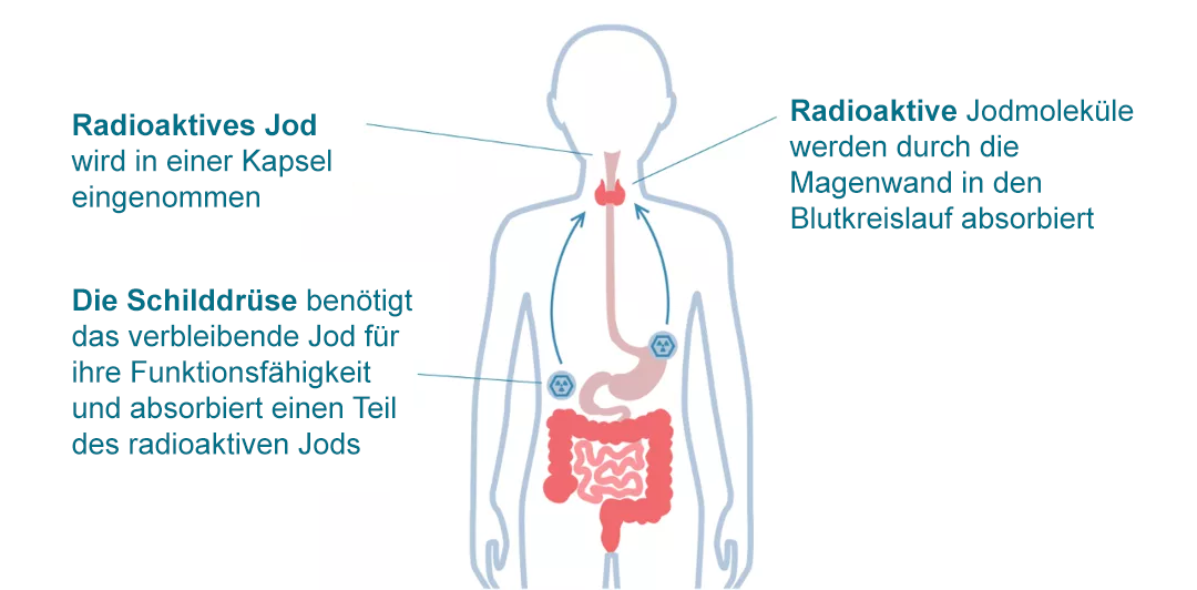 Nuclear Medicine Therapy-de
